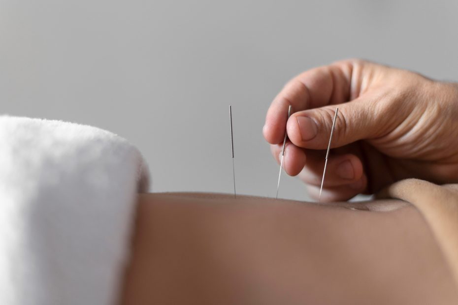 Dry needling involves inserting thin, sterile needles into tight muscles or “trigger points.”